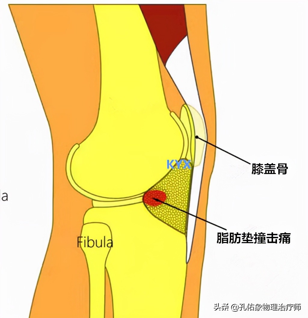 膝关节疼痛位置判断得了什么病,膝关节疼痛一般什么原因引起的