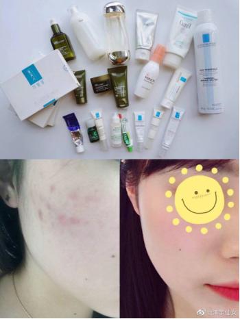 敏感肌怎么祛闭口粉刺痘痘,敏感肌祛闭口最有效的方法