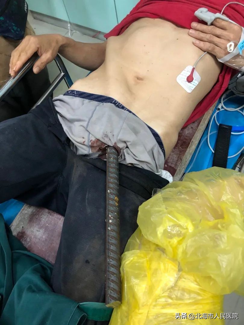 工人被钢筋刺穿身体生死一线抢救,工地钢筋穿过人体事故后续