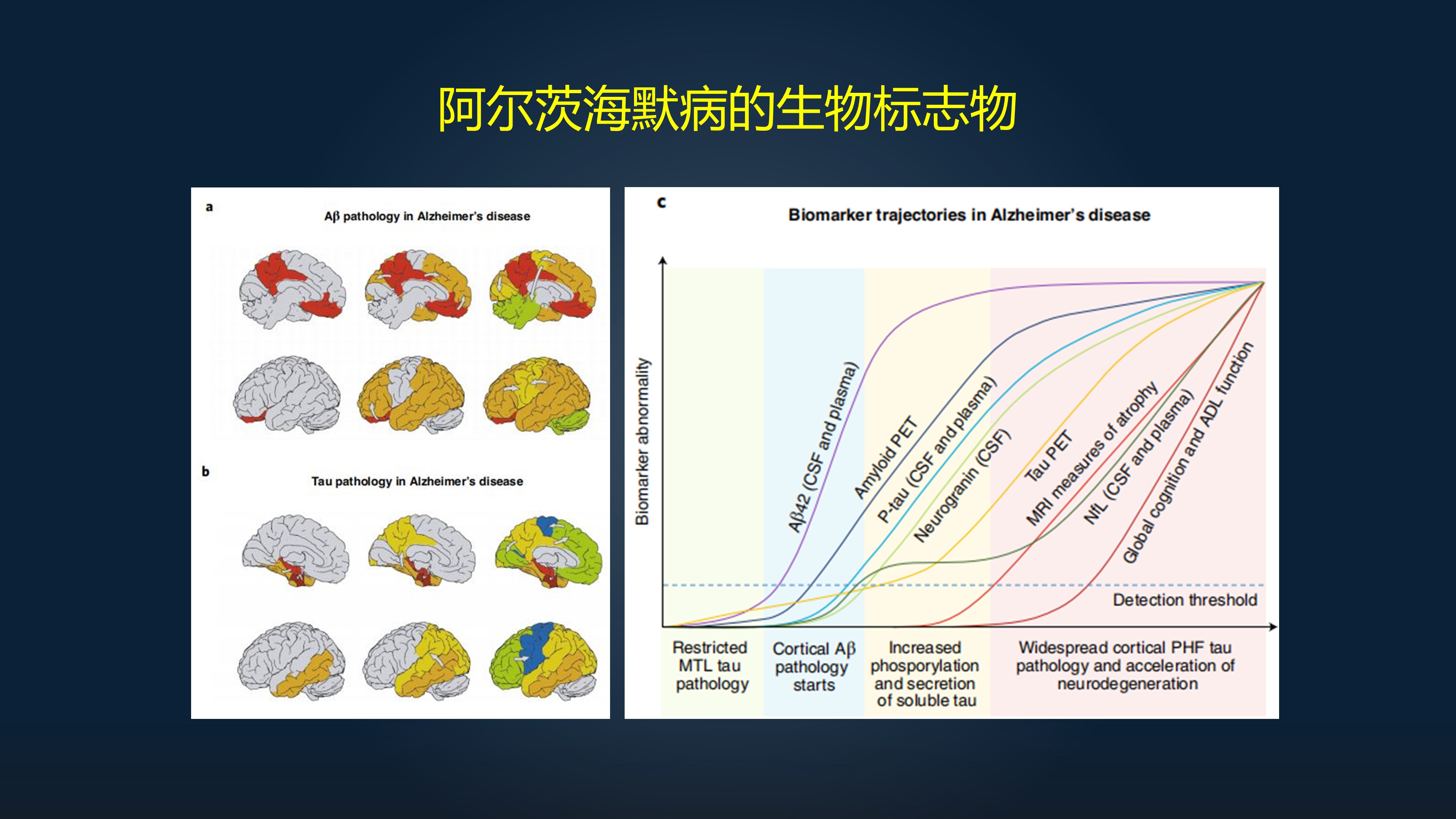 徐文兵谈阿尔茨海默症怎么治,徐俊教授大脑衰老等级