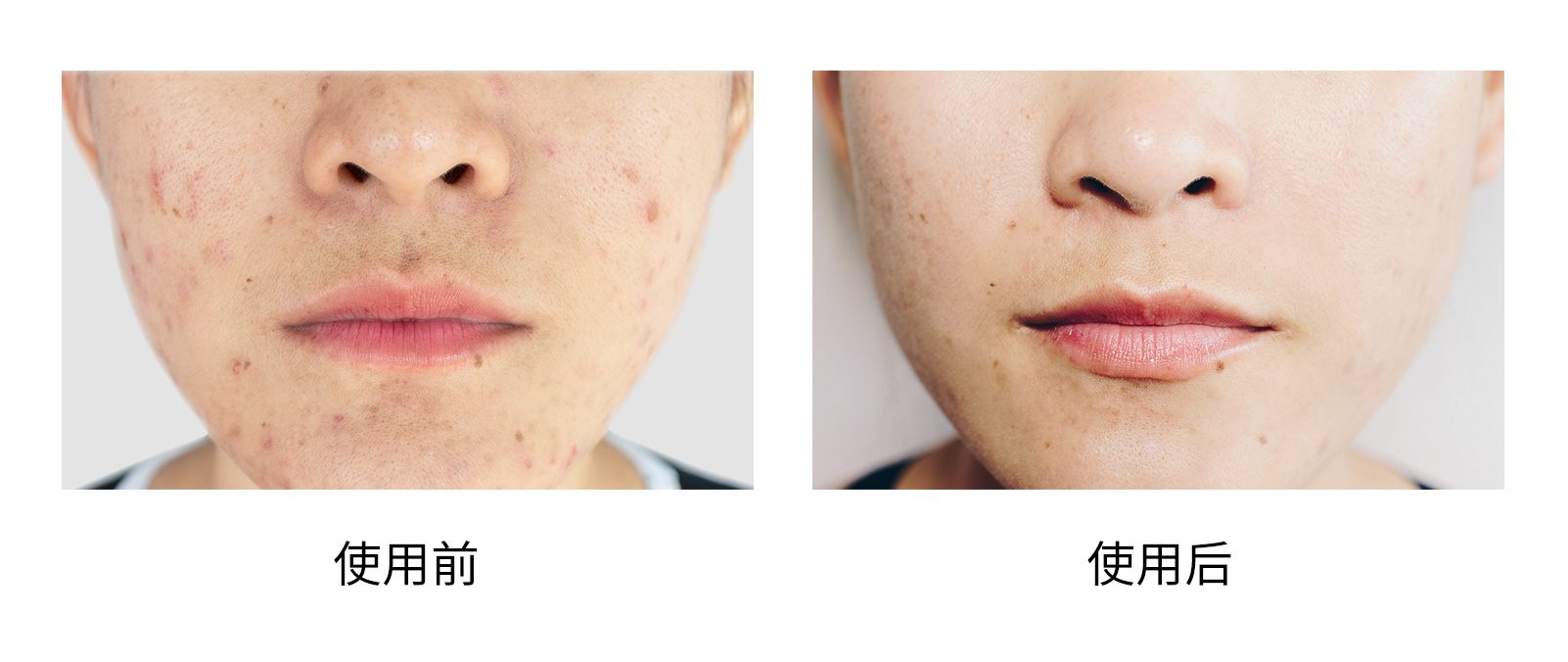 皮肤激光美容后如何护理,激光术后皮肤护理攻略