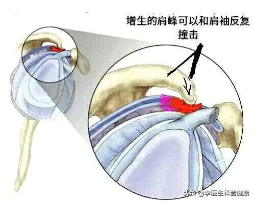 你有肩颈痛的症状吗,肩膀疼的原因和解决方法