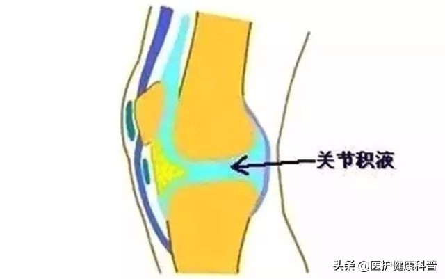 膝盖反复肿是怎么回事,膝盖滑膜炎肿了应该如何按摩