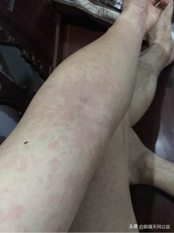 依非韦伦副作用以后可以消除吗,艾滋病依非韦伦最新用量