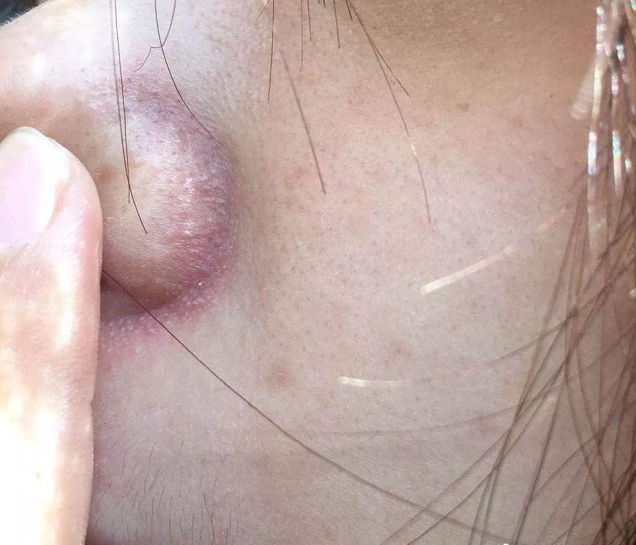 鼻翼总是红红的是什么原因,鼻翼长痘痒痒的红红的