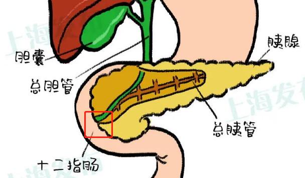一招解决胆结石的方法,胆结石最快止疼方法穴位