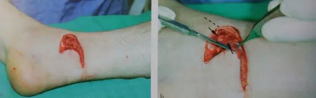 刀口闭合需要多久,伤口闭合除了缝针还有什么方法