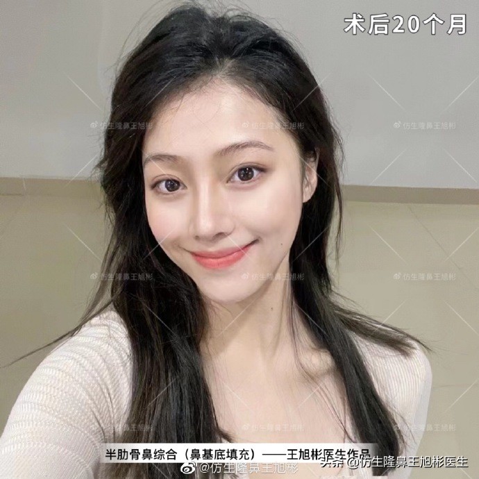 那些被鼻子“封印”颜值的鼻综合/修复案例|广州鼻整形