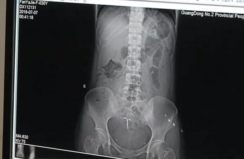 女子不慎从10楼坠落,女子不慎摔下