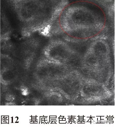 皮肤共聚焦显微镜能查什么,皮肤镜和共聚焦显微镜
