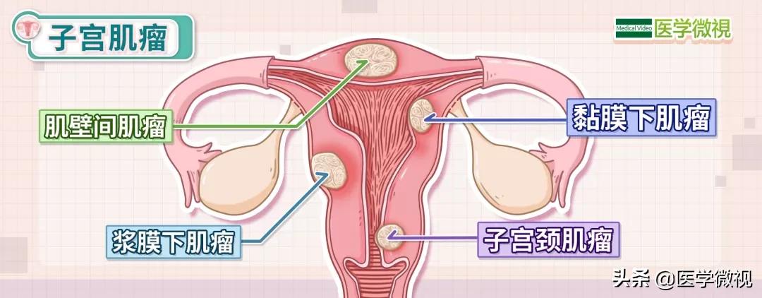 女性多发癌症,女人患上全球仅有300例的罕见肿瘤