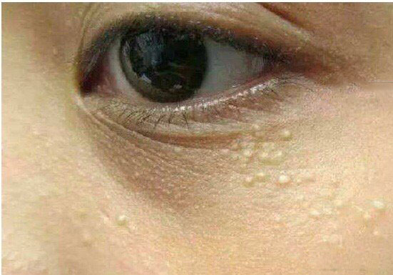 眼部周围的小点点怎么才能消除,去眼部脂肪粒的最好方法