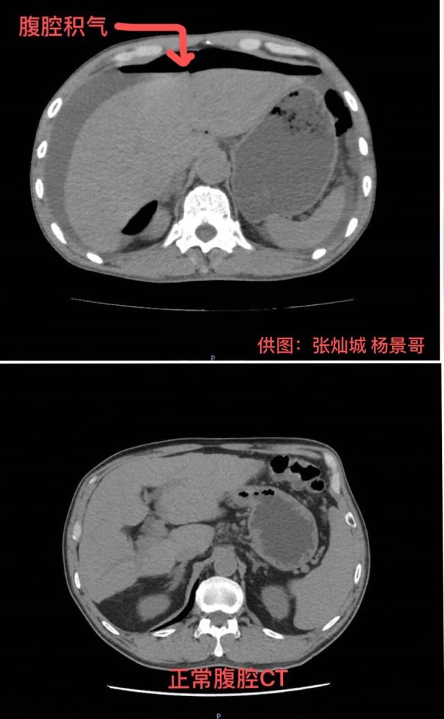 过年不就医？他腹痛忍到胃穿孔，春节险入“鬼门关”