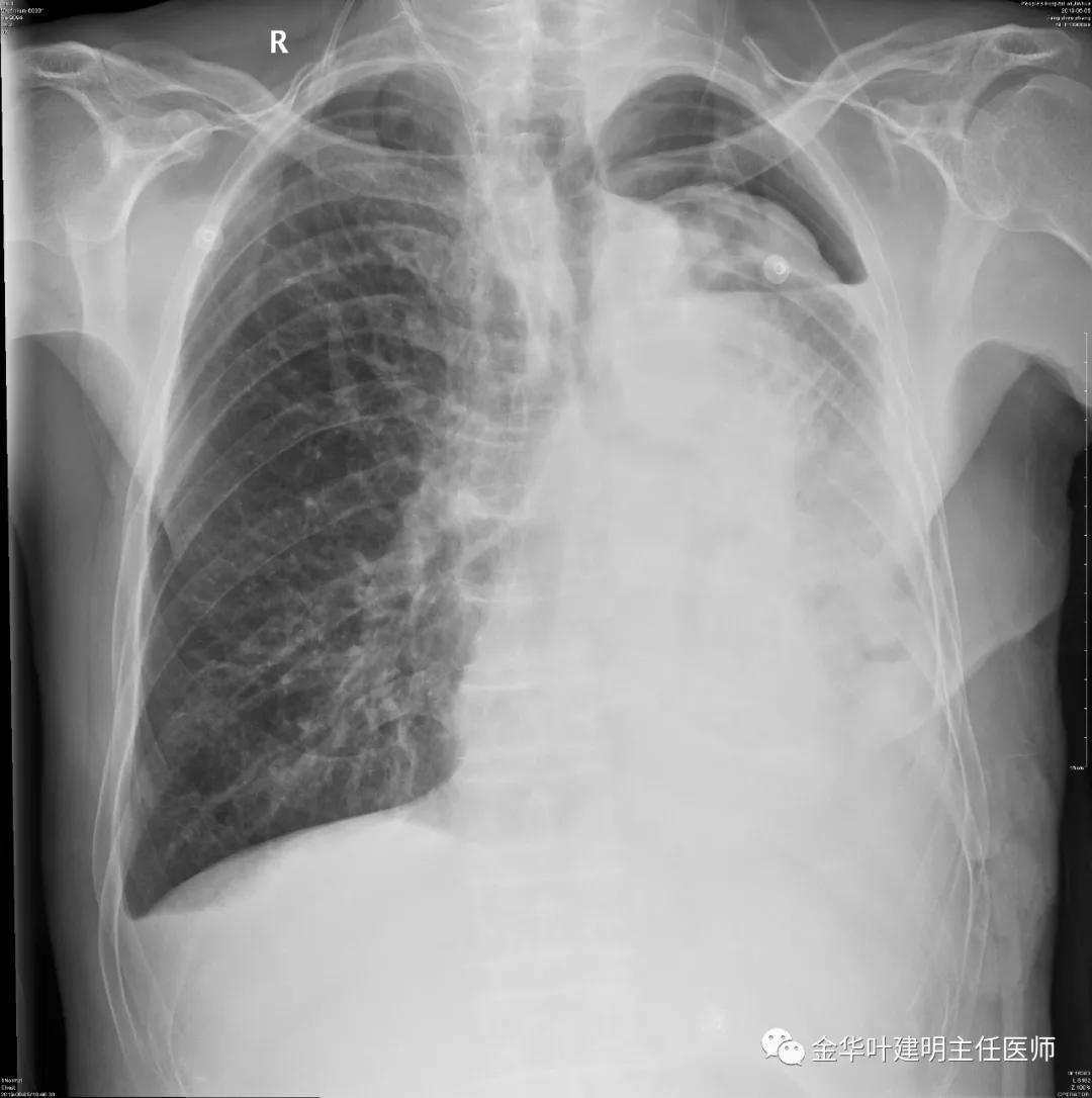 肺手术后乳糜胸是医疗事故吗,肺部切除后乳糜胸治好了