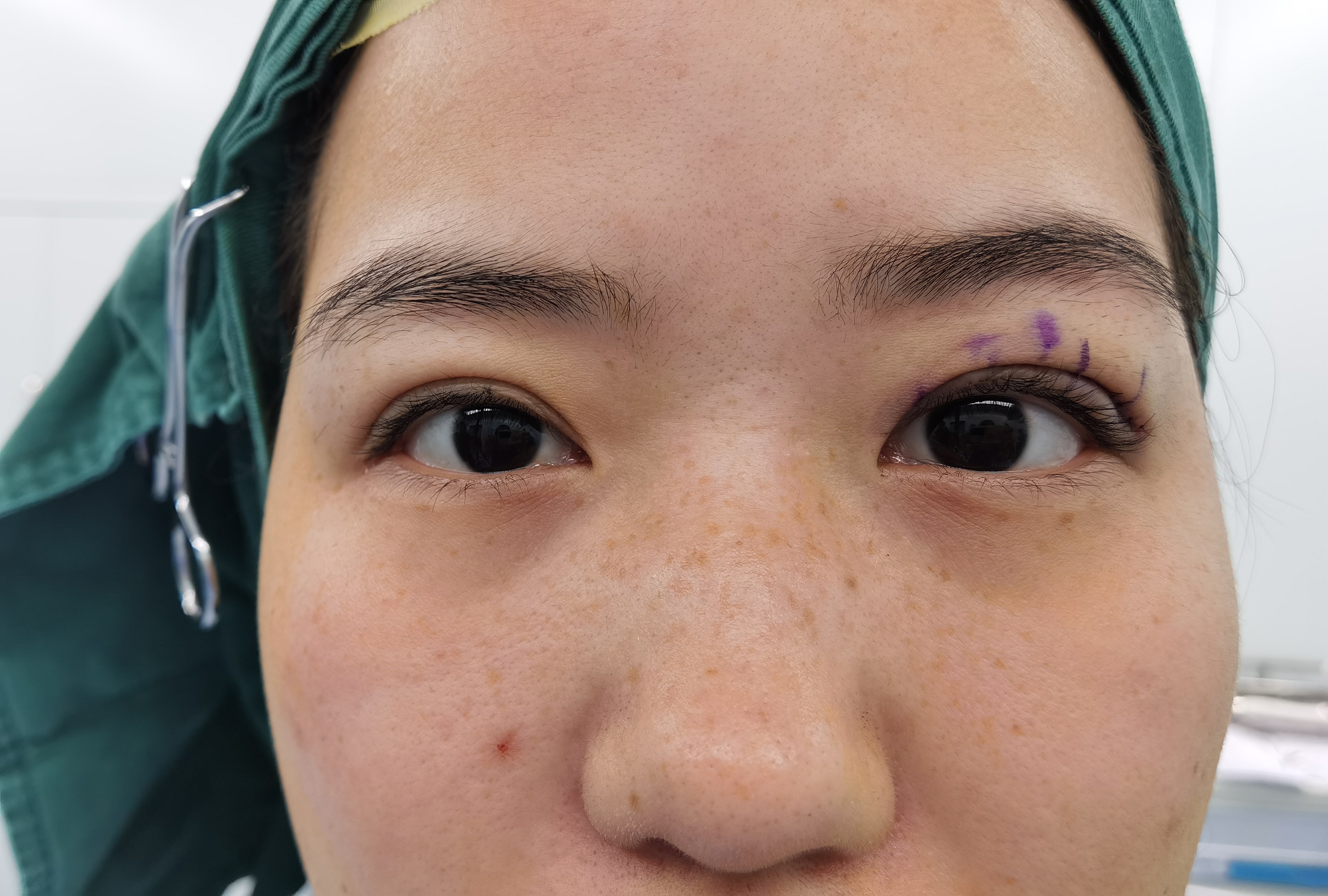 眼睑下垂手术5天恢复图,眼睑下垂手术15天照片