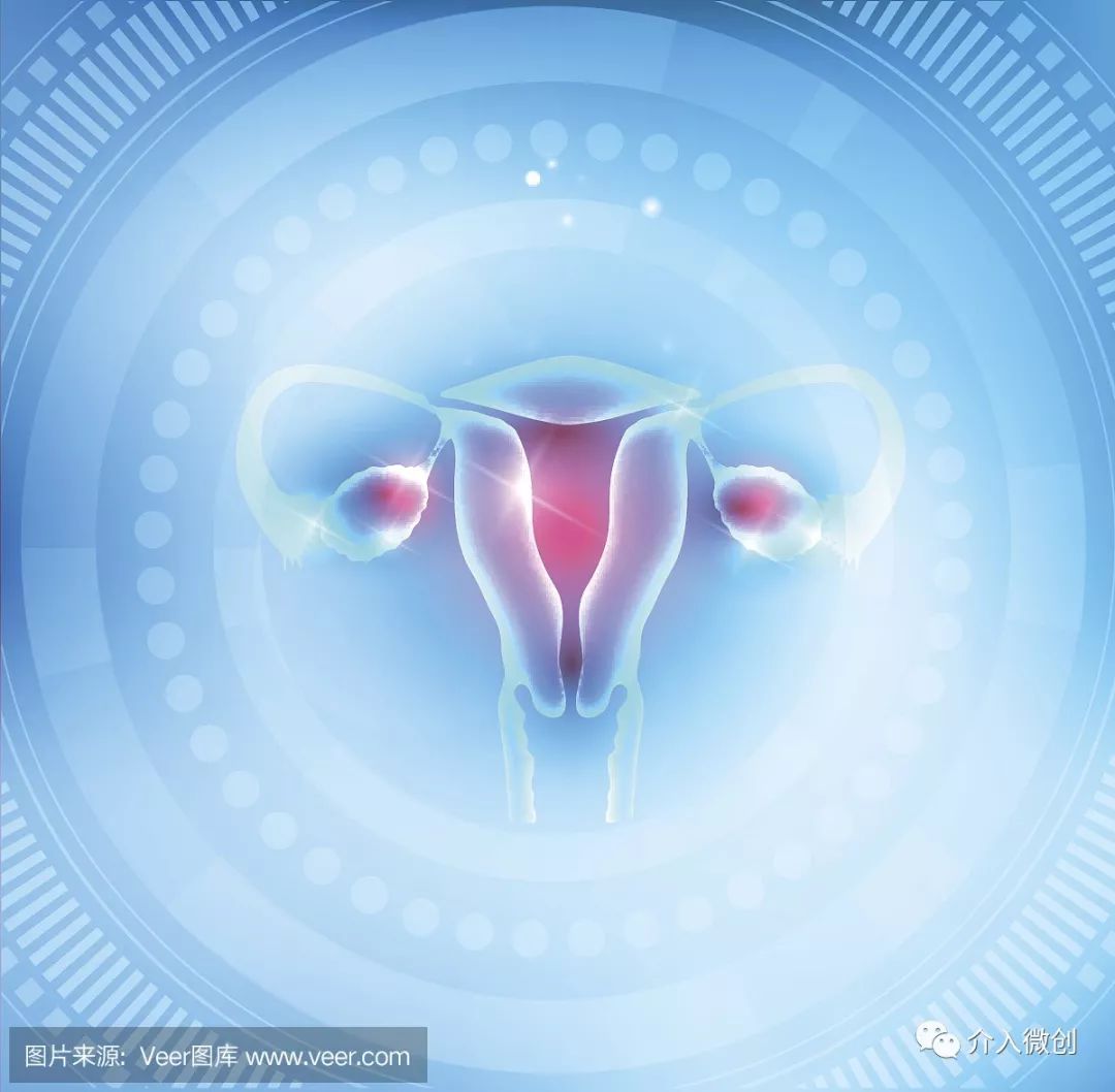 介入微创治疗巧克力囊肿