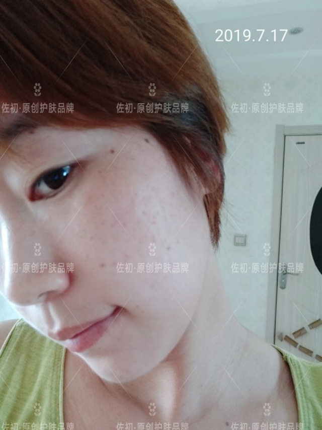 生完孩子烂脸,生完孩子脸上垮了怎样处理