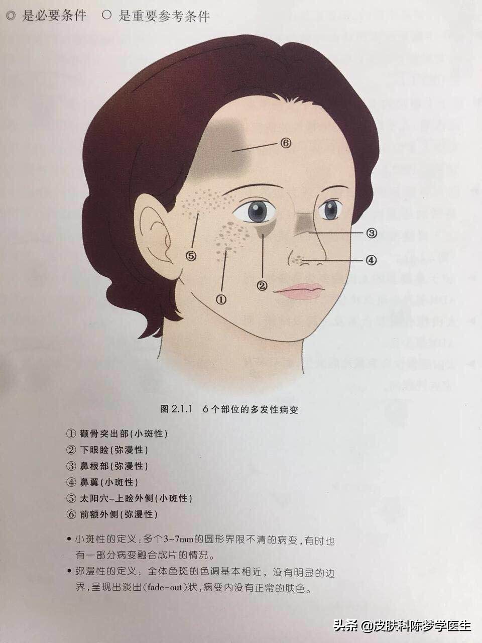 4个治疗面部色斑的方法,25岁脸部色斑怎么治