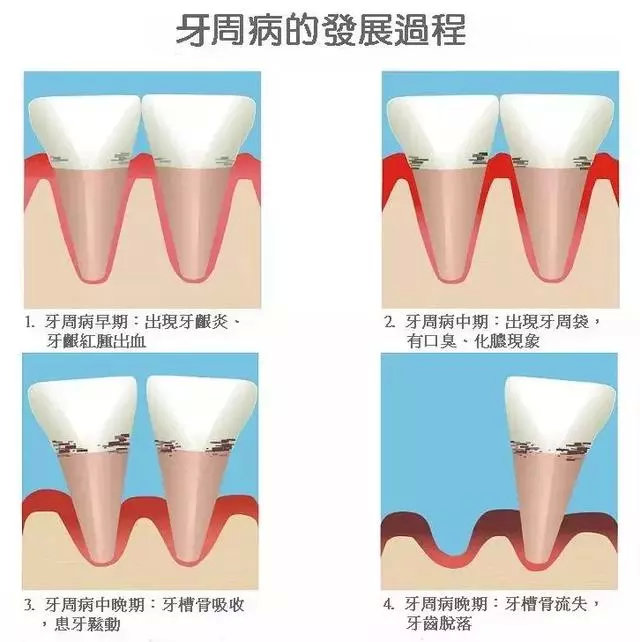 矫正牙齿后一定会出现“黑三角”?形成黑三角的2个原因，关注防范