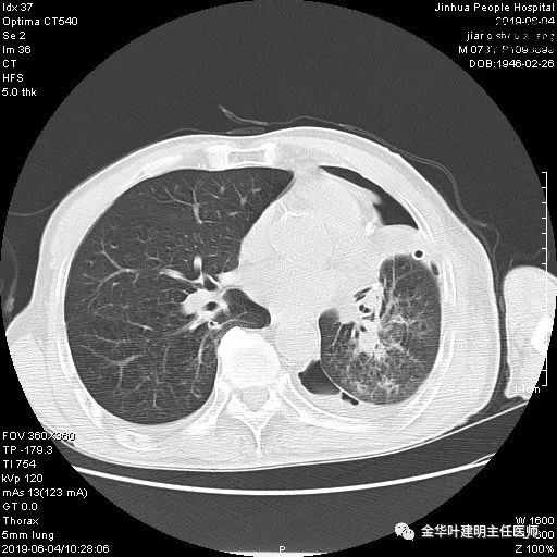肺手术后乳糜胸是医疗事故吗,肺部切除后乳糜胸治好了