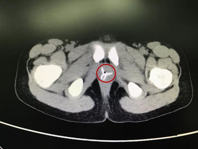 女孩肚子痛还流血，隔了几天走路都不对劲了！