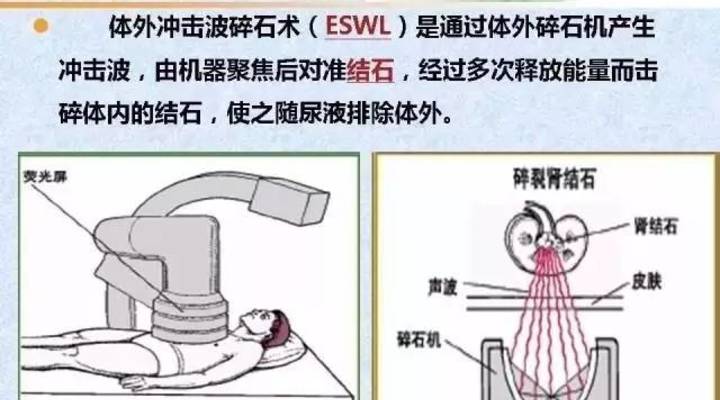 肾结石会自己掉下来是什么原因,肾结石什么原因会掉到输尿管