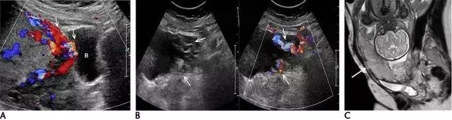 干货分享丨正常胎盘与异常胎盘的超声表现