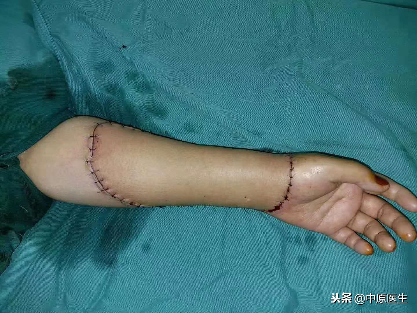 3岁时手臂长肿物16岁前进了5次手术室没根治，53岁被细心专家治好