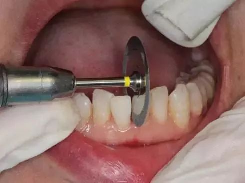 正畸主治学习视频,正畸钟摆效应名词解释