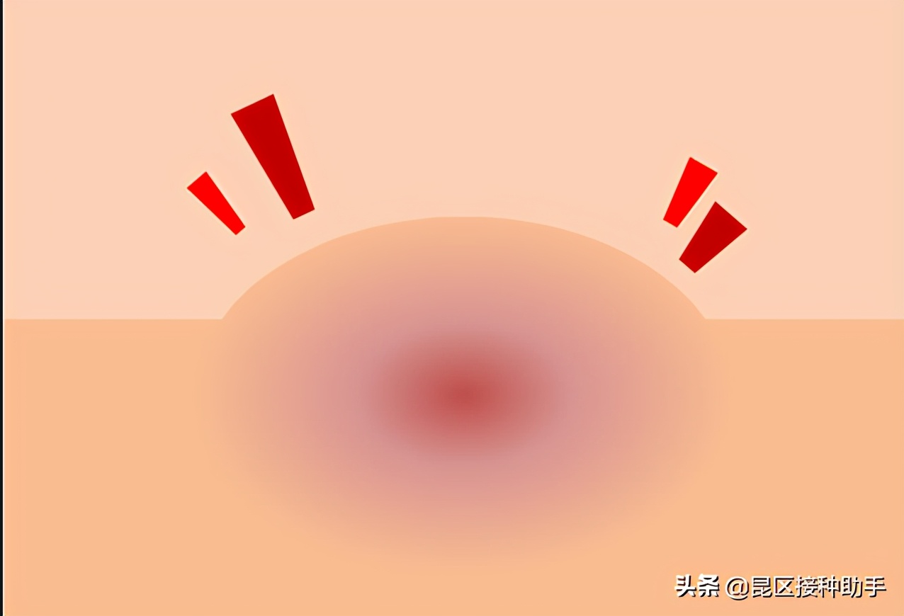 宝宝打完疫苗针眼处有硬结,接种百白破疫苗后红肿硬结怎么办