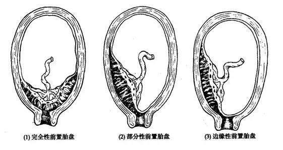 前壁胎盘≠前置胎盘，孕妈要关注区分！