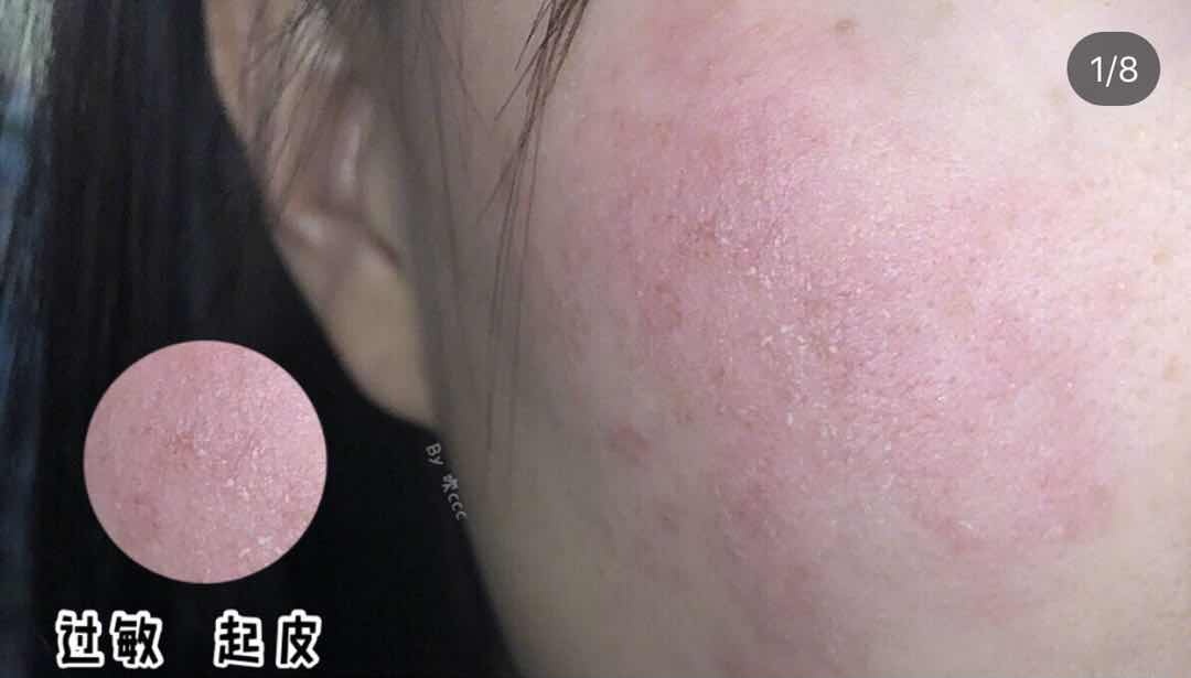 晒伤皮肤修护推荐,适合晒伤修复的护肤品