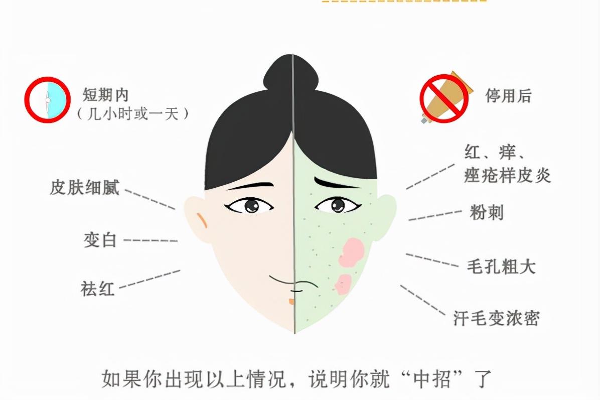 脸部皮炎使用激素药膏可以吗,医用护肤品修复激素依赖性皮炎