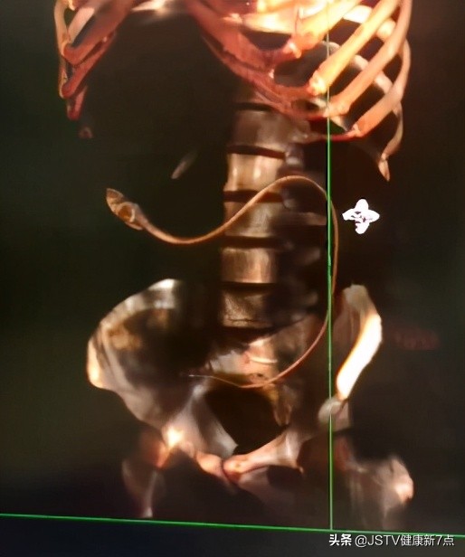 突发！长约40公分黄鳝从男子肛门钻进肚子