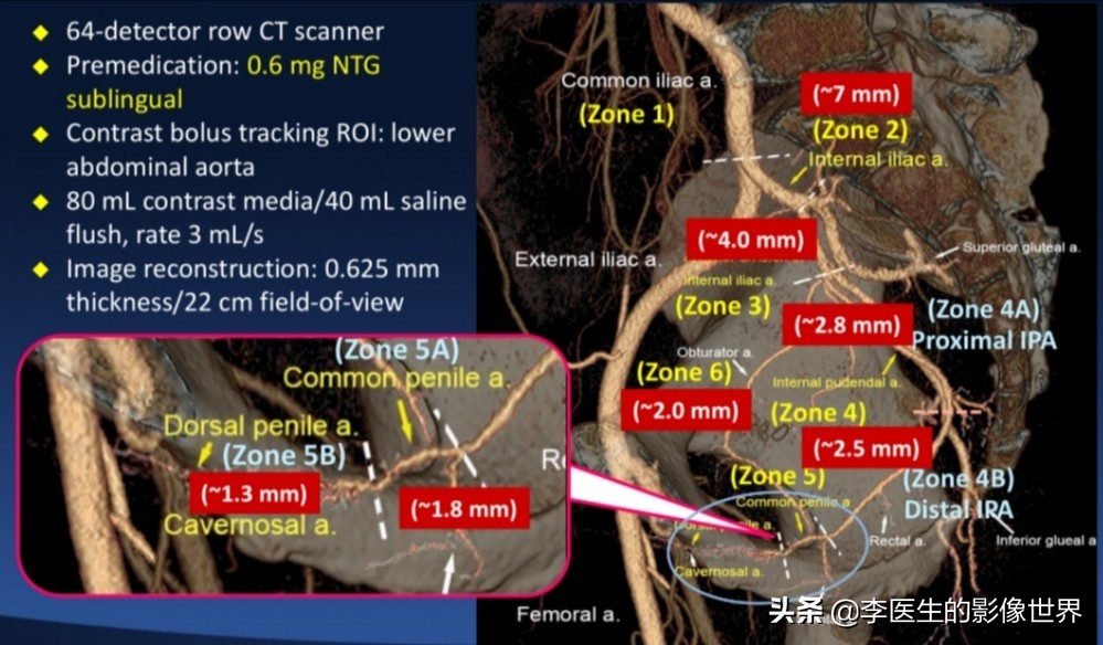 勃起功能障碍,ED之阴部内动脉CT血管成像