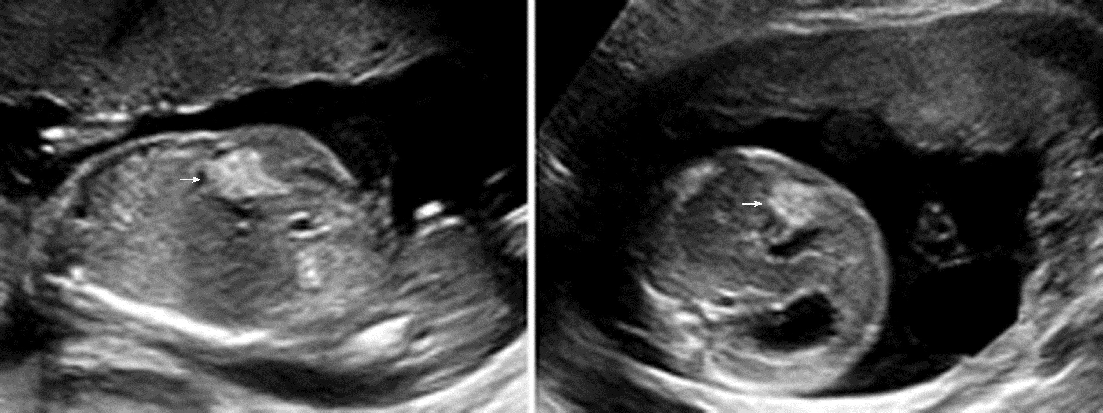 胎儿腹部可见6公分囊性包块,胎儿腹部有肿块怎么回事