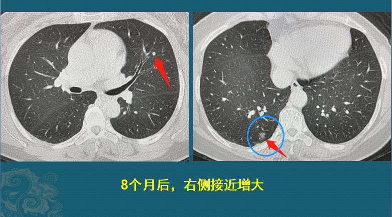 癌细胞增长的速度,癌细胞爆发性扩散