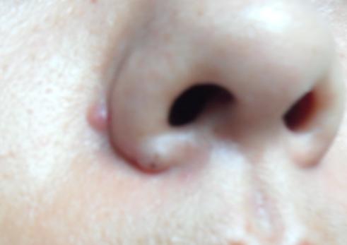 脸上老是长痘怎么祛痘,28岁了脸上老是长痘痘怎么办