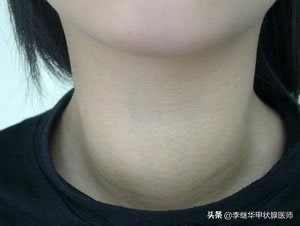 甲功检查里促甲状腺激素偏低,甲功检查促甲状腺激素很高