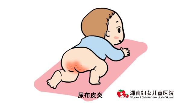 小孩夏天怎么防止痒疹,夏天的宝宝怎么避免热疹