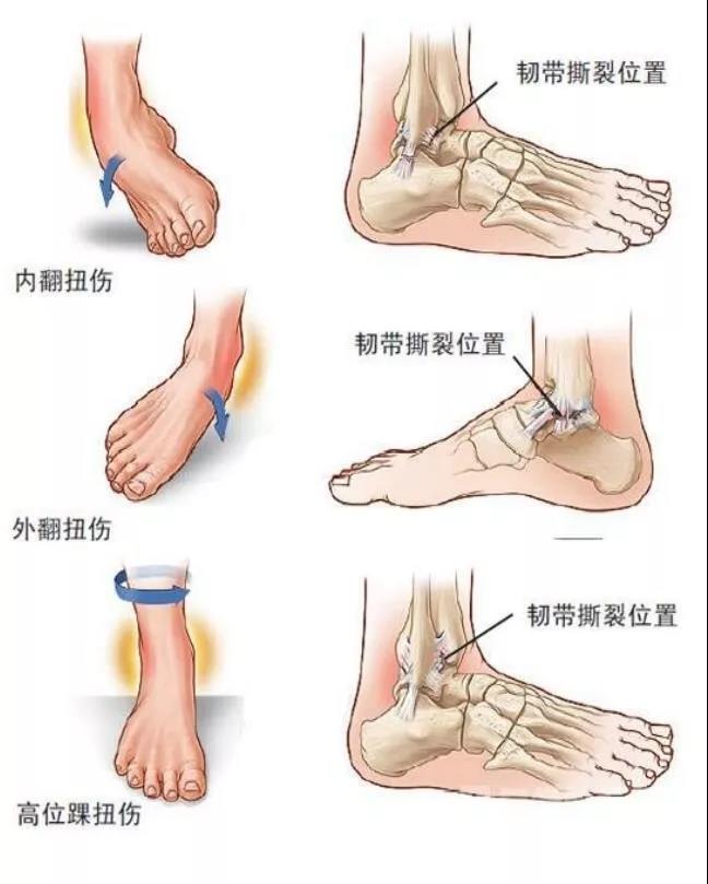 跑步后腿疼脚疼是怎么回事,跑步后腿脚痛如何缓解