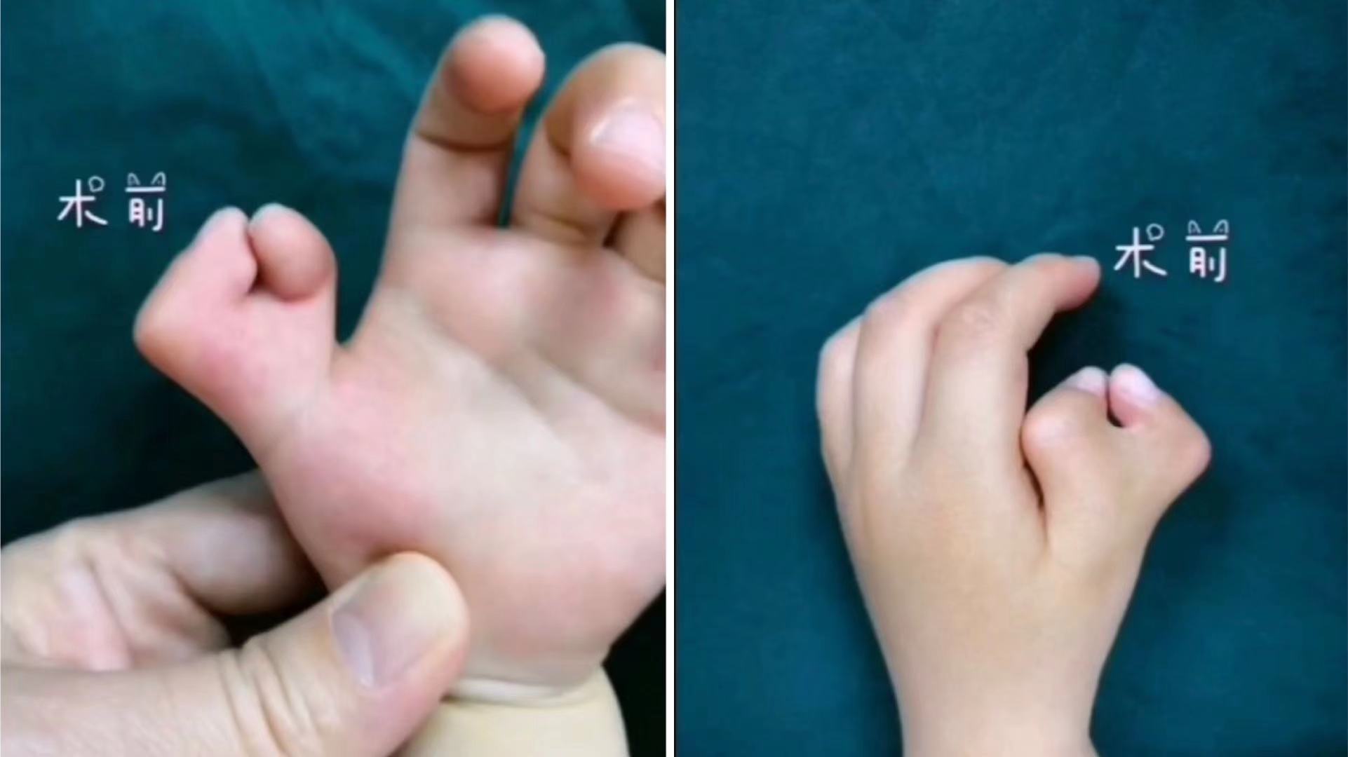 灏忓澶氭寚鐣稿舰鎬庝箞娌荤枟,鍎跨澶氭寚鐣稿舰鏈夊繀瑕佸垏闄ゅ悧