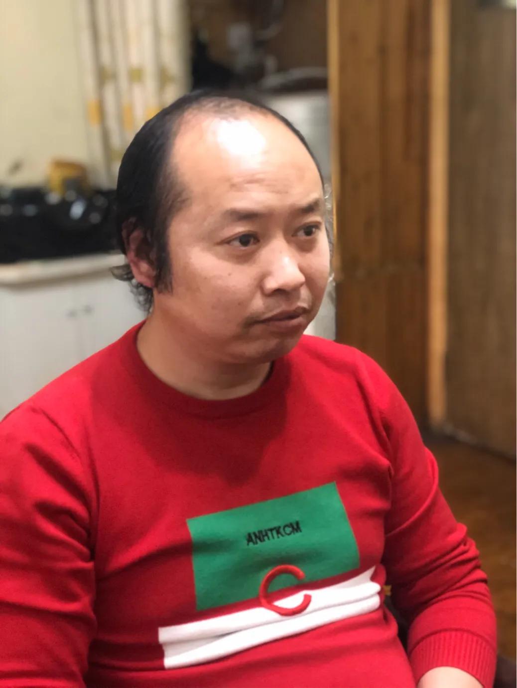 脱发到底该怎么应对,女脱发严重怎么解决