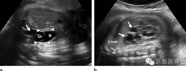 胎儿卵巢囊肿5.6厘米会消失吗,卵巢巨大囊肿与妊娠鉴别