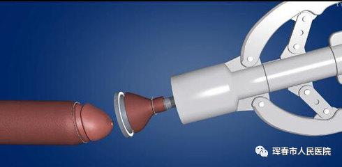 珲春市人民医院泌尿外科成功开展一次性包皮环切吻合器包皮环切新技术