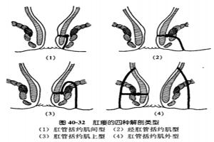 肛瘘要怎么检查才能确诊是肛瘘,什么是肛瘘肛瘘为何必须手术治疗