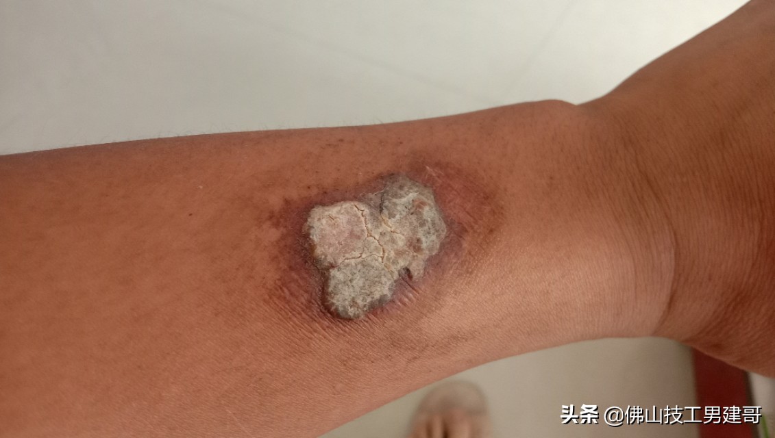 手部烫伤后的康复视频,手烫伤处理视频