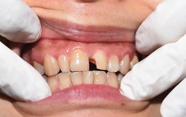 牙齿稀疏牙缝大真的影响财运吗,牙缝越来越宽有什么好办法